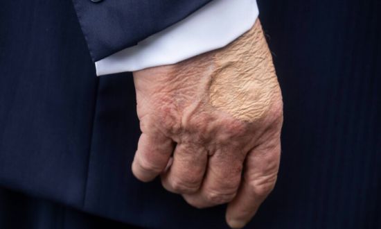 la main de Trump devoile une maladie